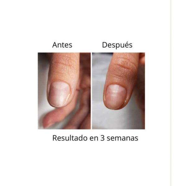 ONISTOP , aceite regenerador para uñas con onicolisis, 8 ml, evita las uñas despegadas. - Imagen 2