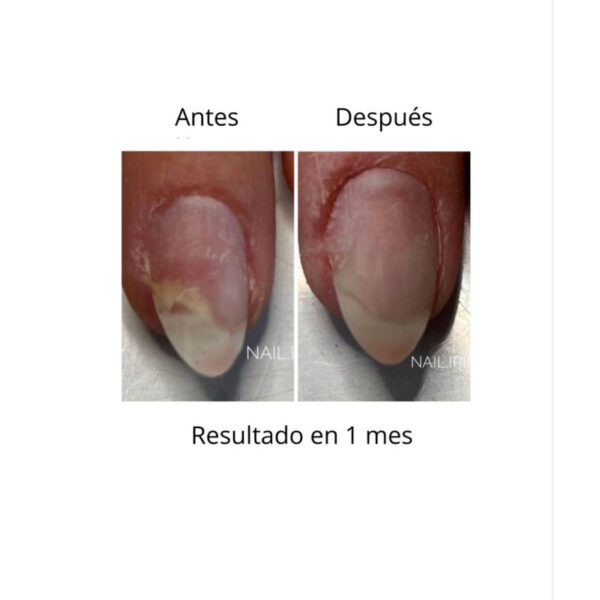 ONISTOP , aceite regenerador para uñas con onicolisis, 8 ml, evita las uñas despegadas. - Imagen 4